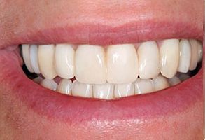 The image shows a close-up view of a person s smile with a focus on their teeth, which are bright white and appear to be well-maintained.