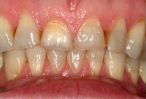 The image shows a close-up view of a person s teeth with severe dental decay and staining, emphasizing oral hygiene concerns.